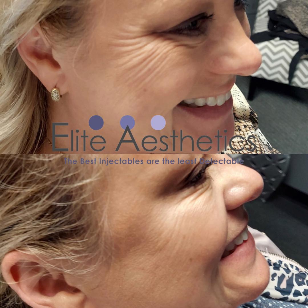 Lip Fillers Before And After 1ml Overland Park Kansas